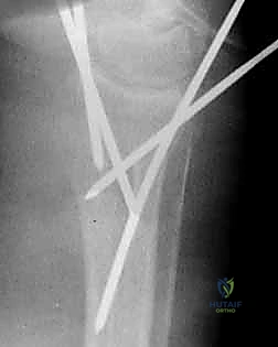 Illustration of without external fixation - Dr. Mohammed Hutaif