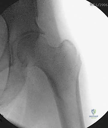 توضيح شكل العظم قبل التدخل الجراحي
