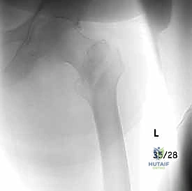 علاج كسور الورك المدورية: دليل شامل للمرضى مع الأستاذ الدكتور محمد هطيف في صنعاء