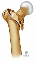 صورة شعاعية توضح نوع الكسر