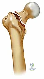 تقييم حالة العظم المتضرر