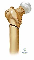 التخطيط الجراحي لكسر الورك