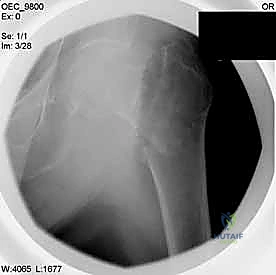 أدوات القياس الدقيقة للغرسة