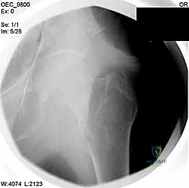 تجهيز الشريحة المعدنية للتثبيت
