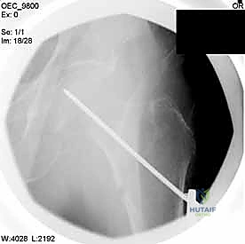 تثبيت الشريحة على العظم