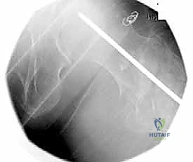 استكمال إدخال الغرسة المعدنية