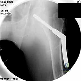 مرحلة الحفر الدقيق داخل العظم