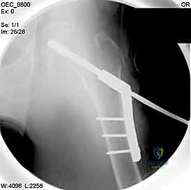 التحضير لتركيب الشريحة الجانبية