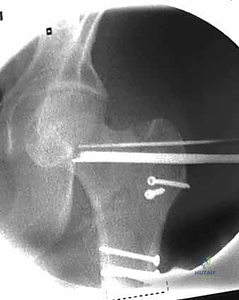 التحكم في عزم الدوران أثناء التثبيت