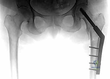 صورة شعاعية نهائية للعملية