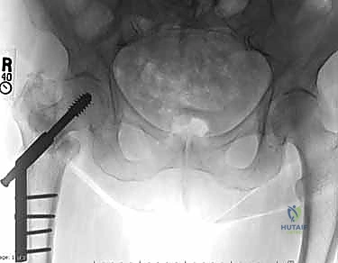 Illustration of peritrochanteric hip fractures - Dr. Mohammed Hutaif