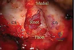 Posterior Cervical Foraminotomy: An Intraoperative Masterclass