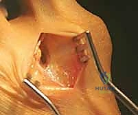 Proximal Crescentic Osteotomy: A Masterclass in Hallux Valgus Correction