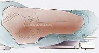 Illustration of proximal femoral replacement - Dr. Mohammed Hutaif