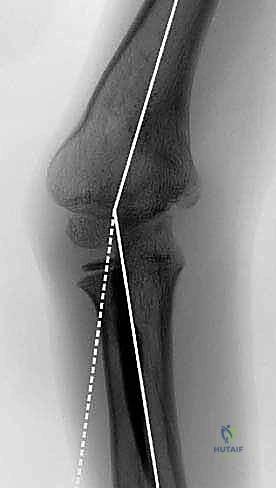 عملية قطع العظم فوق اللقمة لتصحيح تقوس المرفق (Cubitus Varus) عند الأطفال: دليل شامل