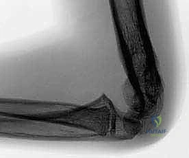 التشريح الدقيق لمفصل المرفق عند الأطفال وتأثير التشوه على المحاذاة