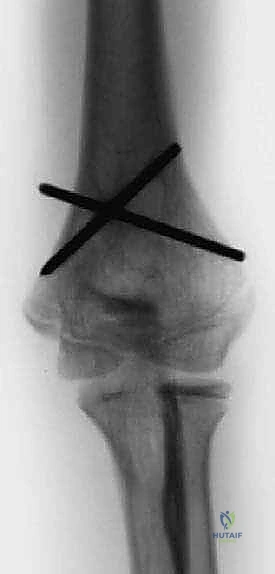 صورة شعاعية توضح التئام العظم بعد عملية قطع العظم فوق اللقمة بنجاح