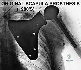 صورة طبية: استئصال الكتف الكلي وإعادة البناء بالطرف الاصطناعي: دليل شامل للمرضى مع الأستاذ الدكتور محمد هطيف