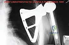 الأستاذ الدكتور محمد هطيف أثناء التخطيط الجراحي لعملية استئصال ورم الكتف