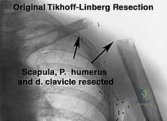 مقارنة بين البتر وجراحة الحفاظ على الطرف