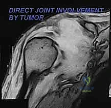 صورة توضيحية لـ استئصال الكتف الكلي وإعادة البناء بالطرف الاصطناعي: دليل شامل للمرضى مع الأستاذ الدكتور محمد هطيف