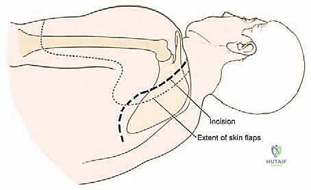 صورة توضيحية لـ استئصال الكتف الكلي وإعادة البناء بالطرف الاصطناعي: دليل شامل للمرضى مع الأستاذ الدكتور محمد هطيف