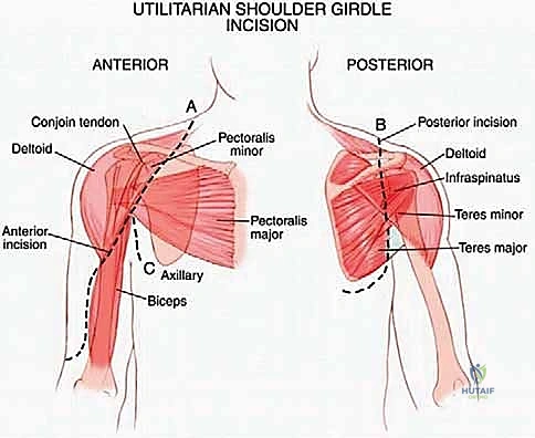 أنواع أورام الكتف الخبيثة والساركوما