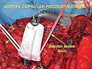 تشريح الكتف المعقد وعظام لوح الكتف