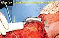 الأعراض التحذيرية لأورام عظام الكتف