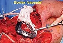 استئصال الكتف الكلي وإعادة البناء بالطرف الاصطناعي: دليل شامل للمرضى مع الأستاذ الدكتور محمد هطيف