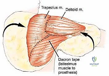 صورة طبية: استئصال الكتف الكلي وإعادة البناء بالطرف الاصطناعي: دليل شامل للمرضى مع الأستاذ الدكتور محمد هطيف