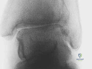 الأستاذ الدكتور محمد هطيف أفضل دكتور عظام في صنعاء