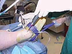 تقنية المنظار الجراحي في علاج الكاحل