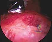 إزالة الغضاريف التالفة من المفصل