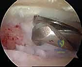 تحضير الأسطح العظمية للدمج