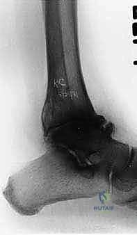 صورة توضيحية لـ تثبيت مفصل الكاحل بالمنظار: حل دائم لآلام التهاب المفصل المزمنة في صنعاء مع الأستاذ الدكتور محمد هطيف