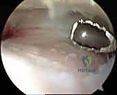 أعراض خشونة الكاحل المتقدمة
