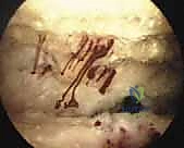 تثبيت العظام باستخدام براغي طبية دقيقة