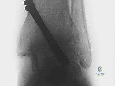 صورة توضيحية لـ تثبيت مفصل الكاحل بالمنظار: حل دائم لآلام التهاب المفصل المزمنة في صنعاء مع الأستاذ الدكتور محمد هطيف