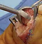Digital & Thumb Joint Arthrodesis: An Intraoperative Masterclass