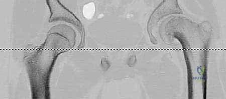Orthopaedic Surgery Board Review: Bone Tumors, Distal Radius Fractures, RA Elbow & Enneking Staging | Part 21562