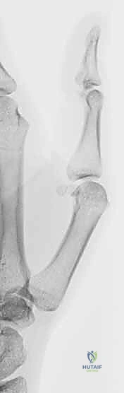 Illustration of metacarpal extension osteotomy - Dr. Mohammed Hutaif