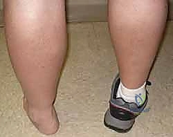 تشوهات القدم الخلفية الشديدة