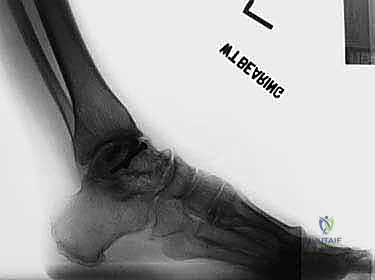 توضيح عظام القدم الخلفية