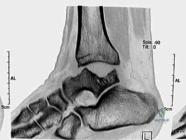 استخدام تقنيات الجراحة الميكروسكوبية في العظام
