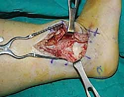 إدخال المسمار النخاعي عبر الكعب