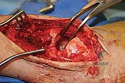 إزالة الغضاريف التالفة من المفصل