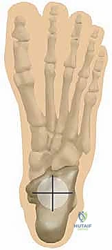 تآكل غضاريف مفصل الكاحل