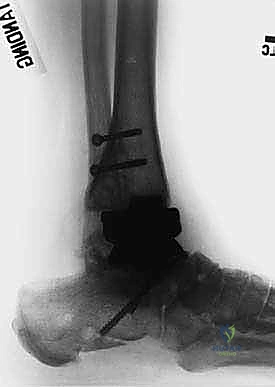 صورة توضيحية لـ تثبيت مفصل الكاحل والقدم الخلفية بالمسمار النخاعي: استعادة الحياة بدون ألم وثبات دائم