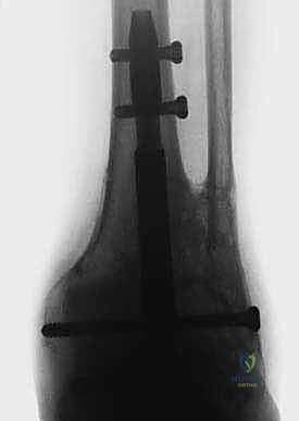 صورة توضيحية لـ تثبيت مفصل الكاحل والقدم الخلفية بالمسمار النخاعي: استعادة الحياة بدون ألم وثبات دائم